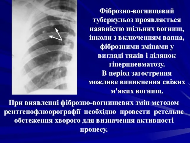 Фіброзно-вогнищевий туберкульоз проявляється наявністю щільних вогнищ, інколи з включенням вапна, фіброзними