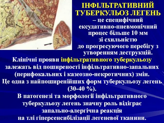 ІНФІЛЬТРАТИВНИЙ ТУБЕРКУЛЬОЗ ЛЕГЕНЬ – це специфічний ексудативно-пневмонічний процес більше 10 мм