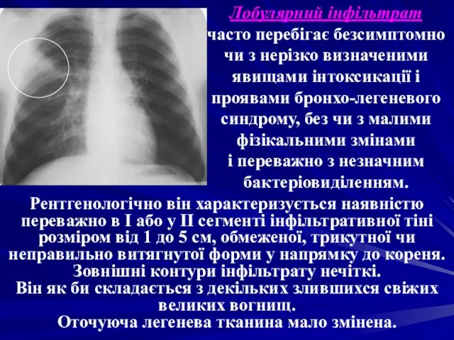 Лобулярний інфільтрат часто перебігає безсимптомно чи з нерізко визначеними явищами інтоксикації