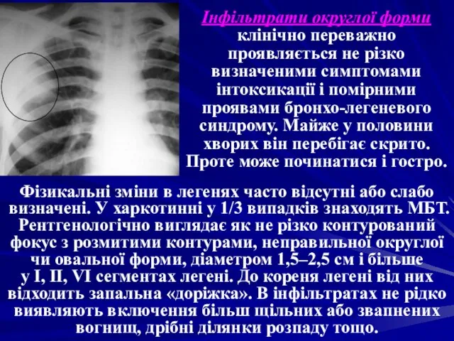 Інфільтрати округлої форми клінічно переважно проявляється не різко визначеними симптомами інтоксикації