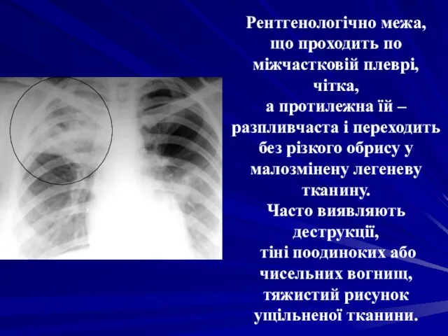 Рентгенологічно межа, що проходить по міжчастковій плеврі, чітка, а протилежна їй