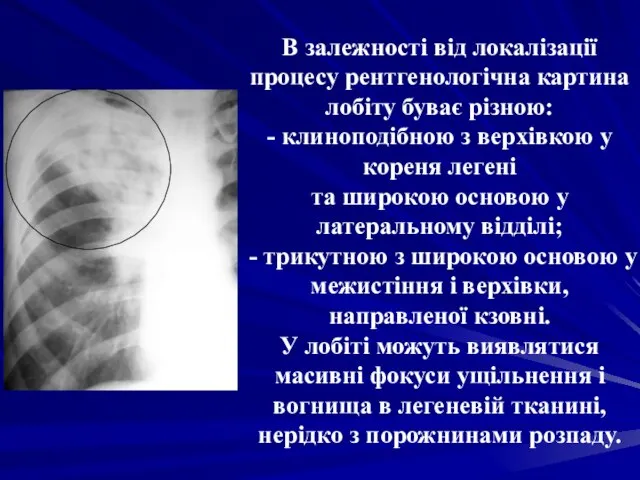 В залежності від локалізації процесу рентгенологічна картина лобіту буває різною: -