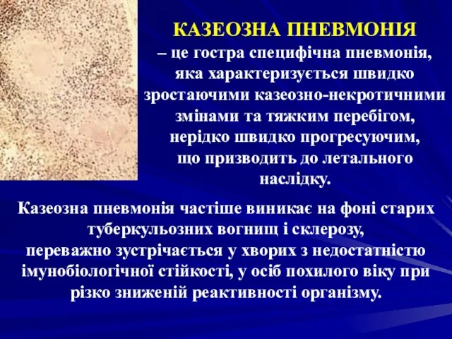 КАЗЕОЗНА ПНЕВМОНІЯ – це гостра специфічна пневмонія, яка характеризується швидко зростаючими