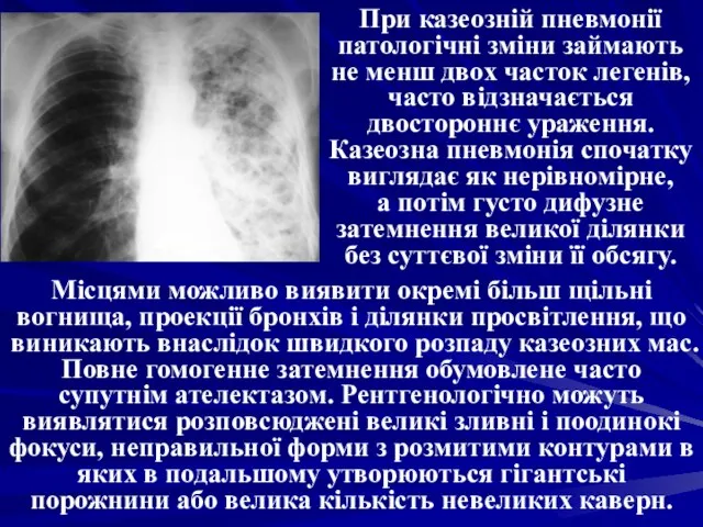 При казеозній пневмонії патологічні зміни займають не менш двох часток легенів,