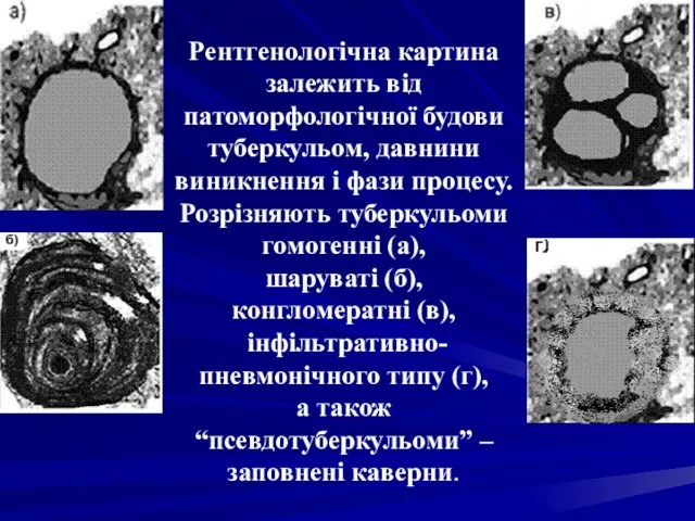 Рентгенологічна картина залежить від патоморфологічної будови туберкульом, давнини виникнення і фази