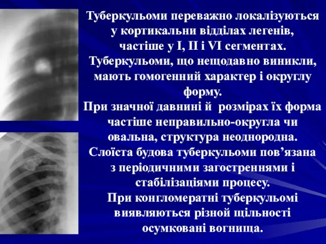 Туберкульоми переважно локалізуються у кортикальни відділах легенів, частіше у I, II