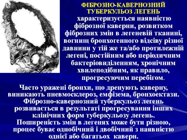 ФІБРОЗНО-КАВЕРНОЗНИЙ ТУБЕРКУЛЬОЗ ЛЕГЕНЬ характеризується наявністю фіброзної каверни, розвитком фіброзних змін в