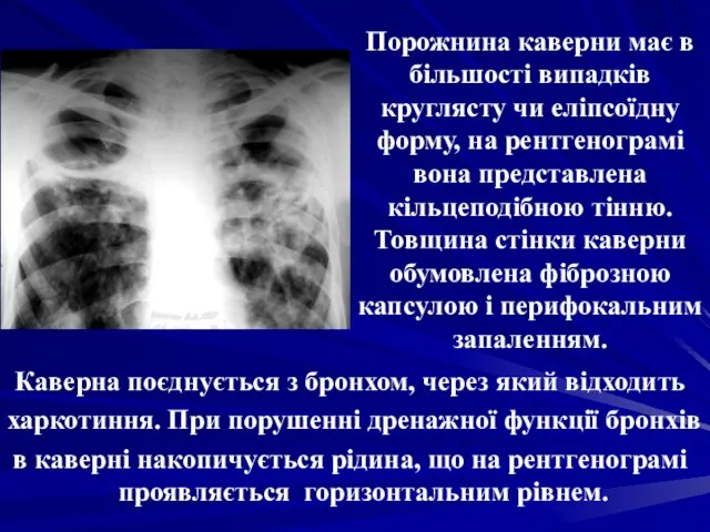 Порожнина каверни має в більшості випадків круглясту чи еліпсоїдну форму, на