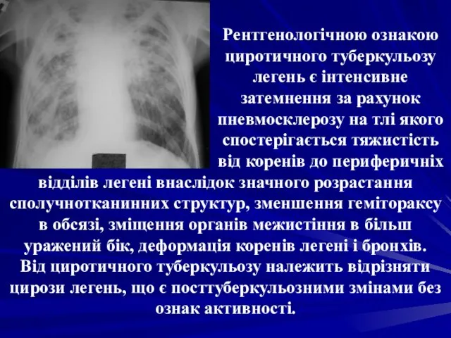 Рентгенологічною ознакою циротичного туберкульозу легень є інтенсивне затемнення за рахунок пневмосклерозу