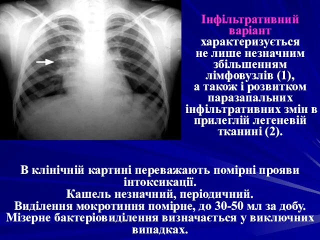 Інфільтративний варіант характеризується не лише незначним збільшенням лімфовузлів (1), а також