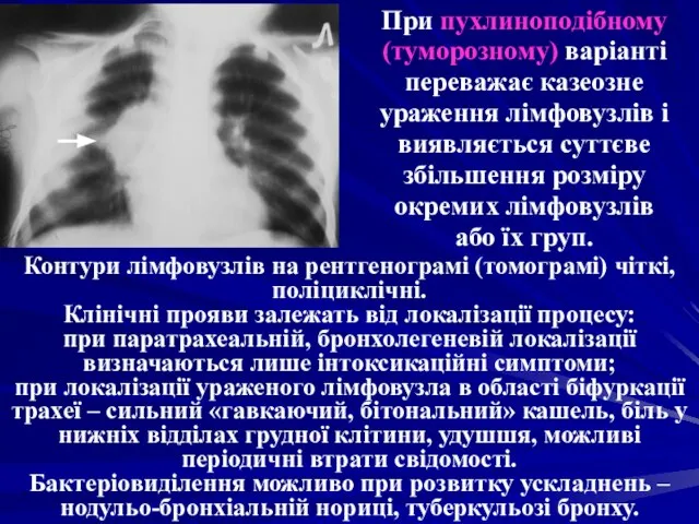 При пухлиноподібному (туморозному) варіанті переважає казеозне ураження лімфовузлів і виявляється суттєве