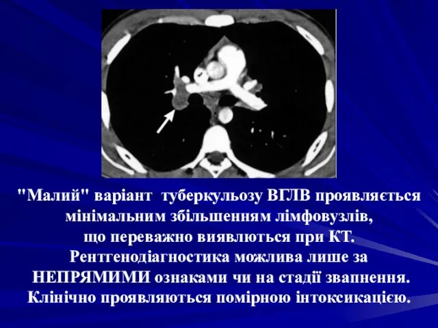 "Малий" варіант туберкульозу ВГЛВ проявляється мінімальним збільшенням лімфовузлів, що переважно виявлються