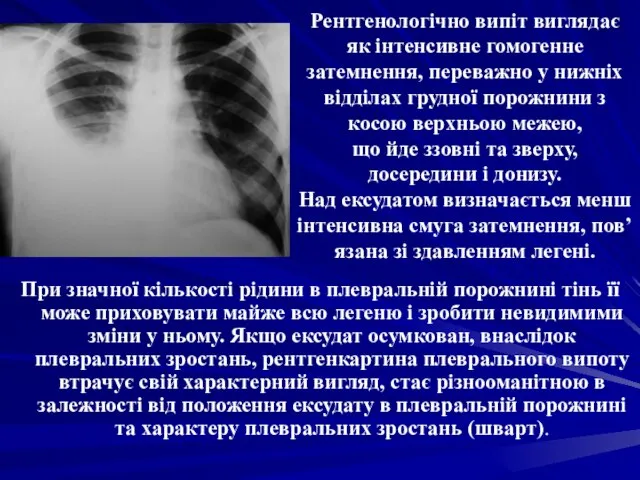 Рентгенологічно випіт виглядає як інтенсивне гомогенне затемнення, переважно у нижніх відділах