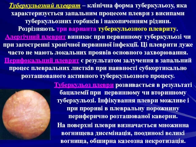 Туберкульозний плеврит – клінічна форма туберкульозу, яка характеризується запальним процесом плеври