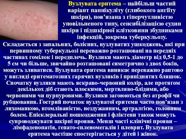 Вузлувата еритема – найбільш частий варіант паннікуліту (глибокого ангіїту шкіри), пов’язана