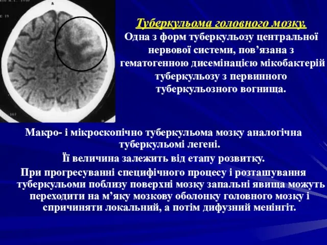 Туберкульома головного мозку. Одна з форм туберкульозу центральної нервової системи, пов’язана