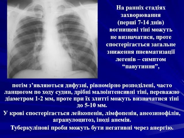 На ранніх стадіях захворювання (перші 7-14 днів) вогнищеві тіні можуть не