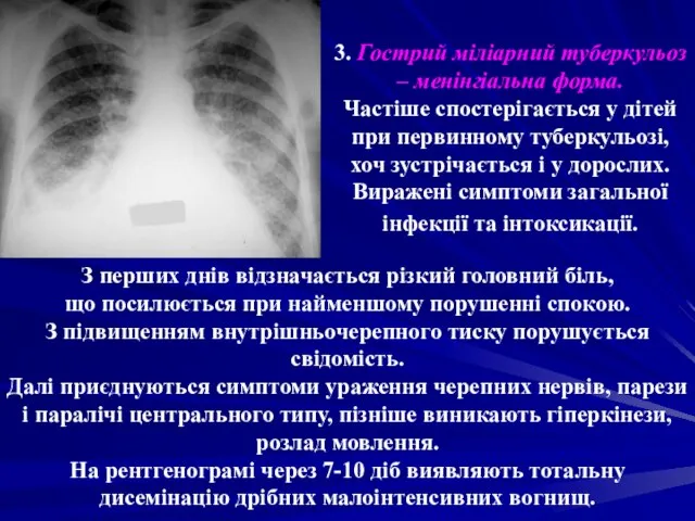 3. Гострий міліарний туберкульоз – менінгіальна форма. Частіше спостерігається у дітей