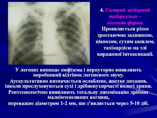 4. Гострий міліарний туберкульоз – легенева форма. Проявляється різко зростаючою задишкою,