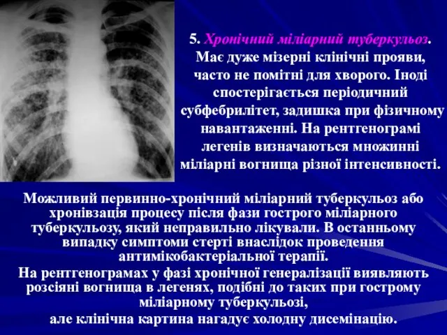 5. Хронічний міліарний туберкульоз. Має дуже мізерні клінічні прояви, часто не