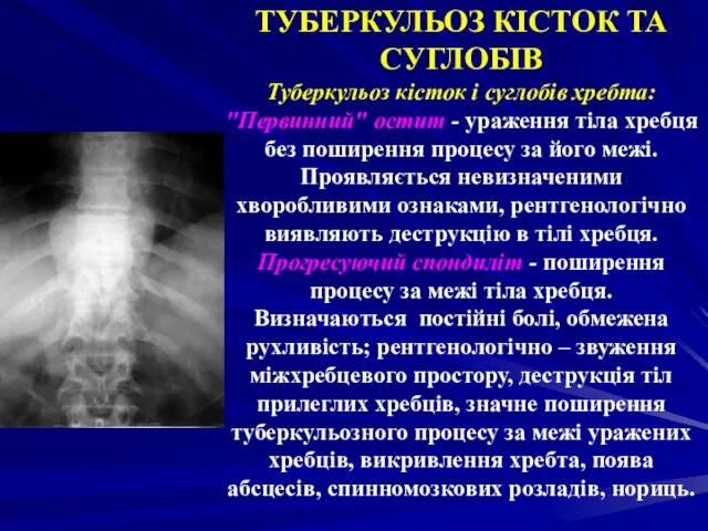 ТУБЕРКУЛЬОЗ КІСТОК ТА СУГЛОБІВ Туберкульоз кісток і суглобів хребта: "Первинний" остит