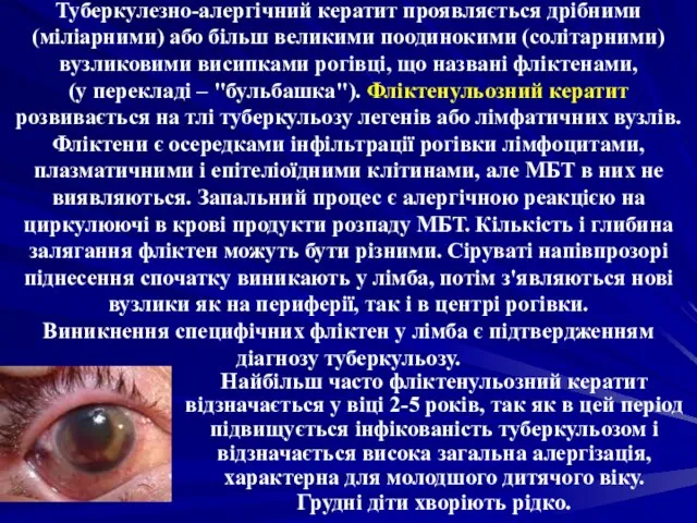 Туберкулезно-алергічний кератит проявляється дрібними (міліарними) або більш великими поодинокими (солітарними) вузликовими