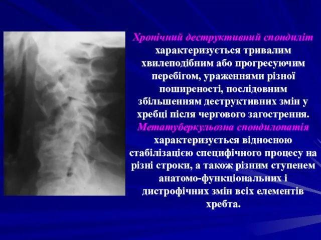 Хронічний деструктивний спондиліт характеризується тривалим хвилеподібним або прогресуючим перебігом, ураженнями різної