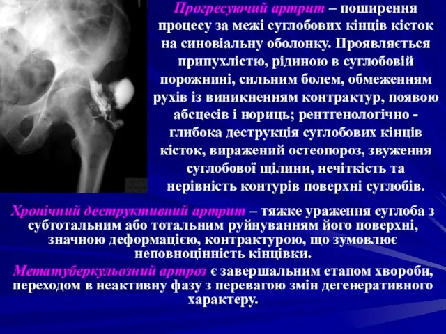 Прогресуючий артрит – поширення процесу за межі суглобових кінців кісток на