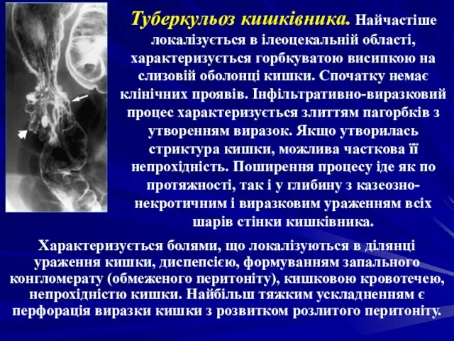 Туберкульоз кишківника. Найчастіше локалізується в ілеоцекальній області, характеризується горбкуватою висипкою на