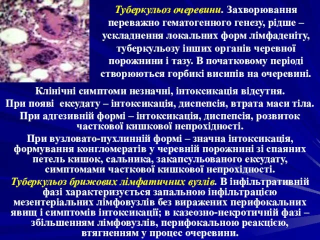 Туберкульоз очеревини. Захворювання переважно гематогенного генезу, рідше – ускладнення локальних форм