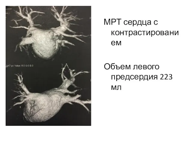 МРТ сердца с контрастированием Объем левого предсердия 223 мл