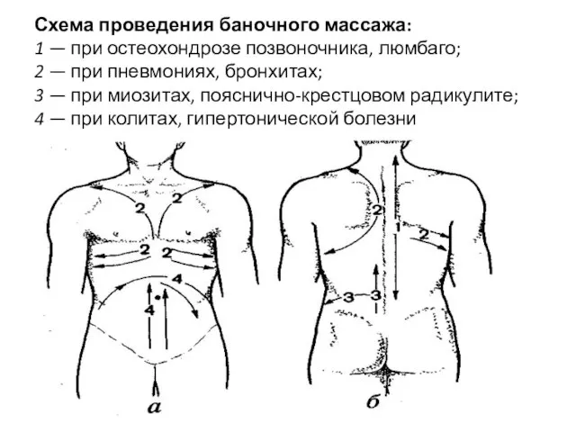Схема проведения баночного массажа: 1 — при остеохондрозе позвоночника, люмбаго; 2