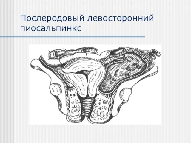 Послеродовый левосторонний пиосальпинкс