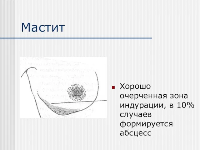 Мастит Хорошо очерченная зона индурации, в 10% случаев формируется абсцесс