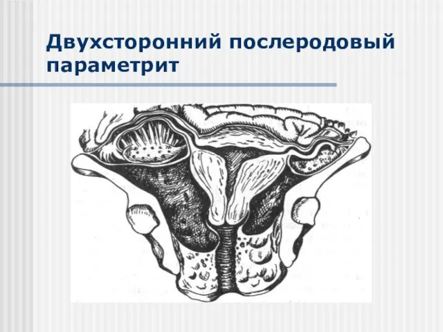 Двухсторонний послеродовый параметрит