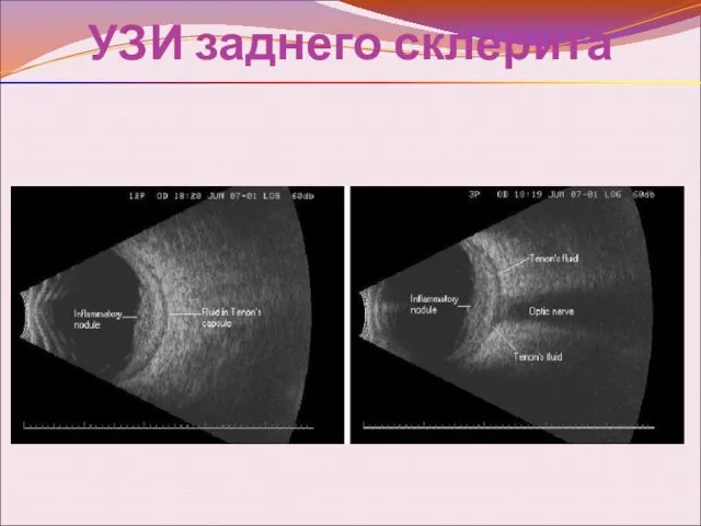 УЗИ заднего склерита
