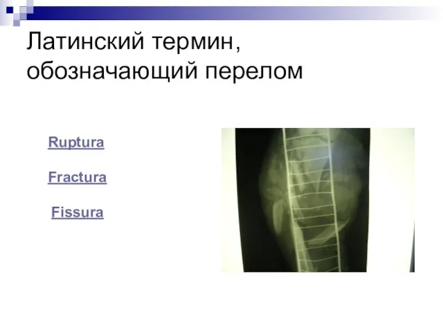 Латинский термин, обозначающий перелом Ruptura Fractura Fissura