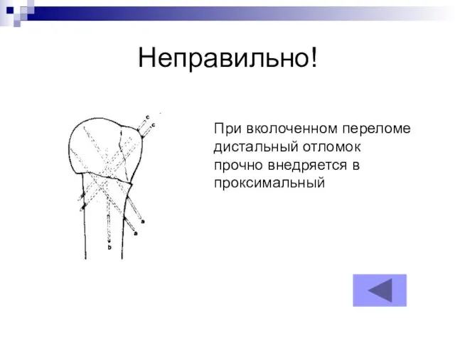 Неправильно! При вколоченном переломе дистальный отломок прочно внедряется в проксимальный