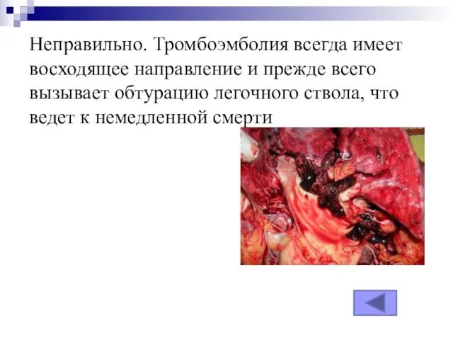 Неправильно. Тромбоэмболия всегда имеет восходящее направление и прежде всего вызывает обтурацию