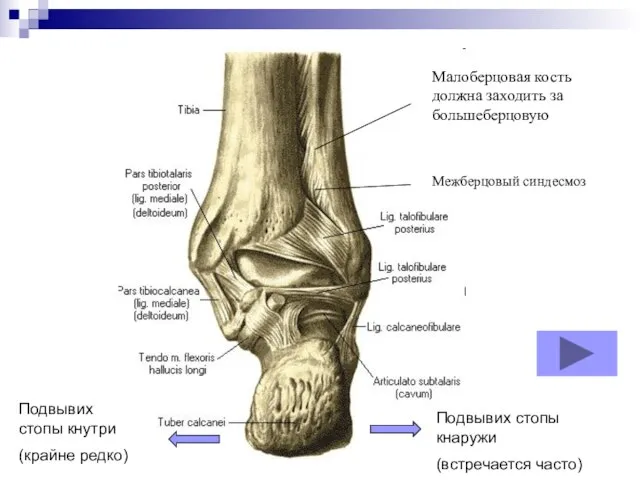 Межберцовый синдесмоз Малоберцовая кость должна заходить за большеберцовую Подвывих стопы кнутри