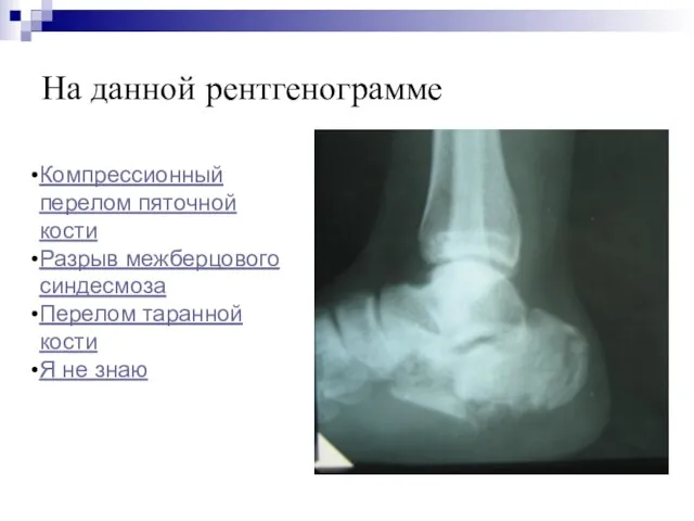 На данной рентгенограмме Компрессионный перелом пяточной кости Разрыв межберцового синдесмоза Перелом таранной кости Я не знаю
