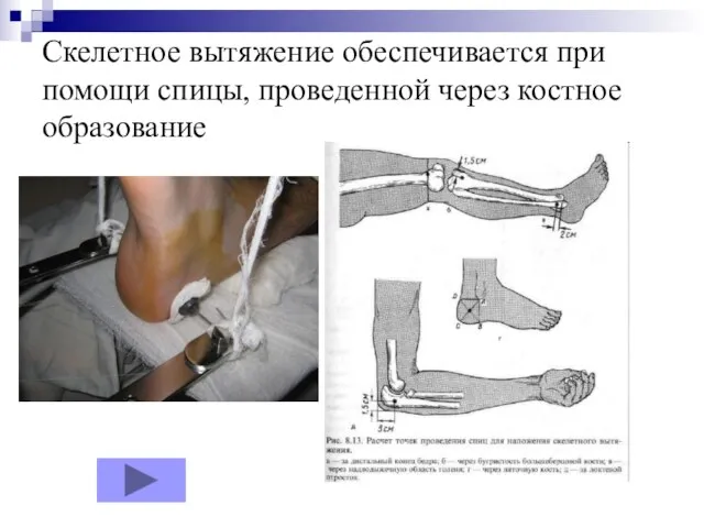 Скелетное вытяжение обеспечивается при помощи спицы, проведенной через костное образование