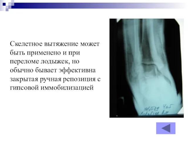 Скелетное вытяжение может быть применено и при переломе лодыжек, но обычно