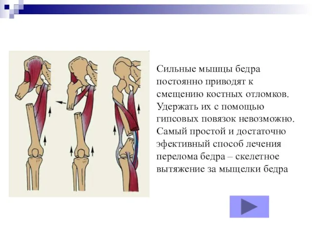 Сильные мышцы бедра постоянно приводят к смещению костных отломков. Удержать их