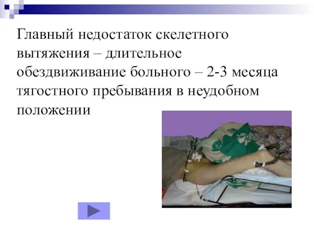 Главный недостаток скелетного вытяжения – длительное обездвиживание больного – 2-3 месяца тягостного пребывания в неудобном положении