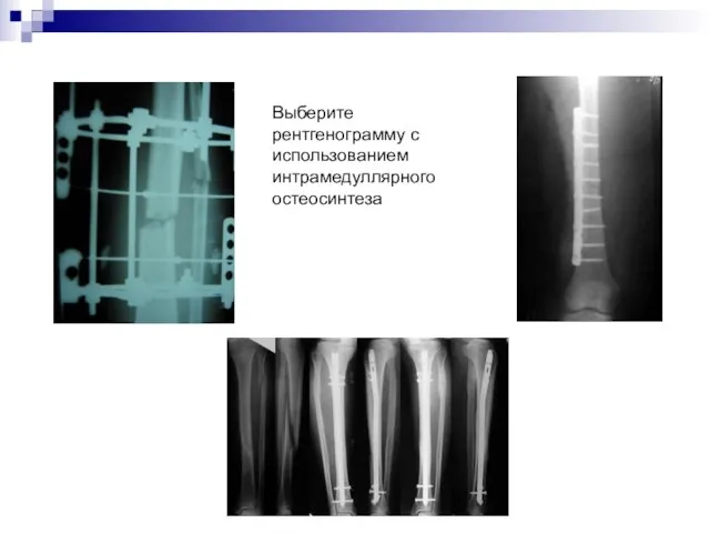 Выберите рентгенограмму с использованием интрамедуллярного остеосинтеза