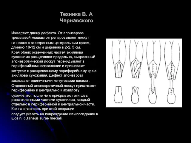 Техника В. А Чернавского Измеряют длину дефекта. От апоневроза трехглавой мышцы