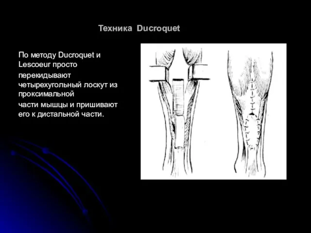 Техника Ducroquet По методу Ducroquet и Lescoeur просто перекидывают четырехугольный лоскут