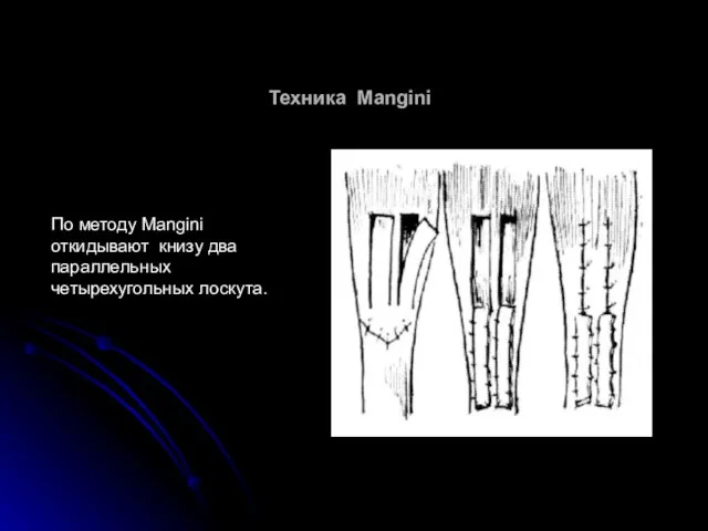 Техника Mangini По методу Mangini откидывают книзу два параллельных четырехугольных лоскута.