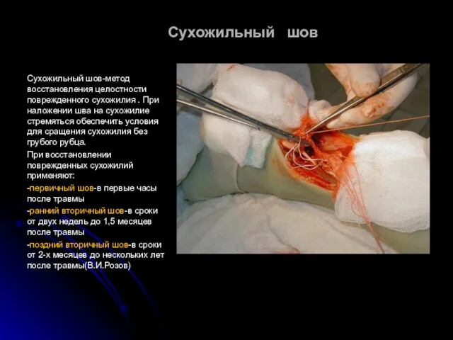 Сухожильный шов Сухожильный шов-метод восстановления целостности поврежденного сухожилия . При наложении